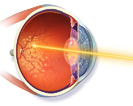 Retina Checkup Vile Parle