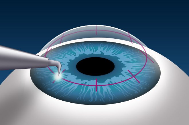 Cornea Eye Doctor In Vile Parle