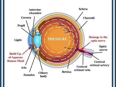 Glaucoma Treatment In Vile Parle